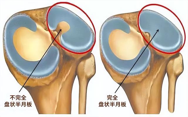 半月板到底是个啥？半月板损伤能自己长好吗？