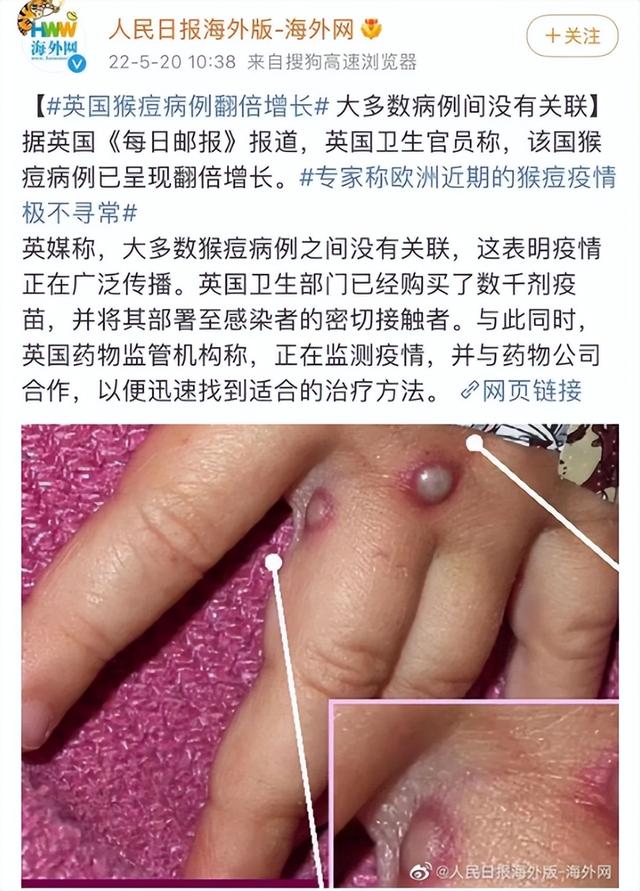 猴痘疫情快报：猴痘到底是什么？危险吗？