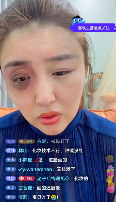 娇娇怎么了？右眼被打黑青，曾在直播间怒斥赵本山一家是黑社会
