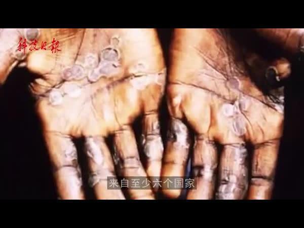 欧美多国现罕见猴痘病例，会成为下一个大流行病吗？