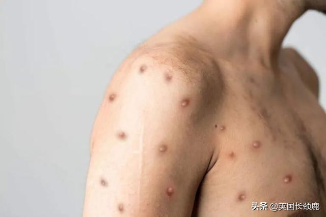 猴痘会成为全球流行病吗？英国建议猴痘高风险人群隔离3周