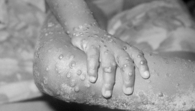 多国确诊，正发生社区传播！“猴痘病毒”用英语怎么说