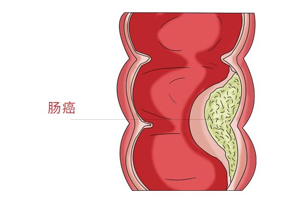 碳水摄入量，与肠癌有关系？关于碳水的合理摄入，真要了解清楚