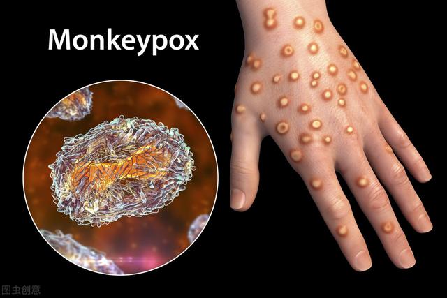 截至8月1日猴痘累计确诊23620例！美国逼近6千例