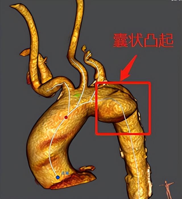 江西首例！南昌大学第二附属医院周为民教授运用新型支架为主动脉弓部动脉瘤患者完成弓上三分支重建术