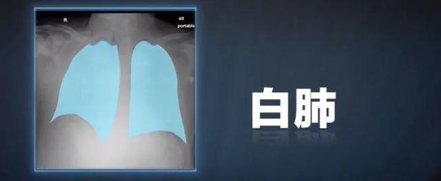 一位美国医生总结：为什么中国"大白肺”这么多？