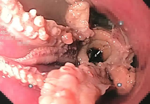 新加坡男子生吞章鱼后呕吐不止，去医院才发现：整只章鱼卡食道里