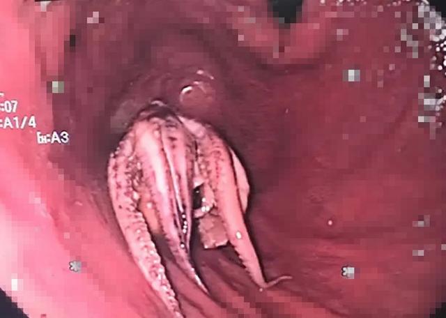 新加坡男子生吞章鱼后呕吐不止，去医院才发现：整只章鱼卡食道里